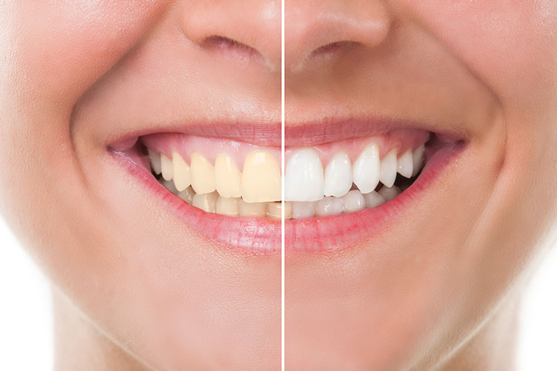 Teeth Whitening in Las Vegas